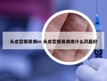 头皮型银屑病m 头皮型银屑病用什么药最好