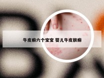 牛皮癣六个宝宝 婴儿牛皮肤癣