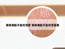 银屑病能不能吃雪菜 银屑病能不能吃雪莲果