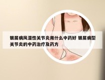 银屑病风湿性关节炎用什么中药好 银屑病型关节炎的中药治疗及药方