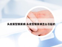头皮屑型银屑病 头皮型银屑病怎么引起的
