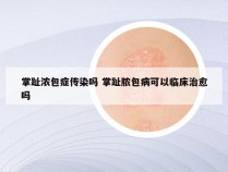 掌趾浓包症传染吗 掌趾脓包病可以临床治愈吗