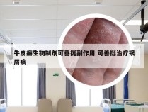 牛皮癣生物制剂可善挺副作用 可善挺治疗银屑病