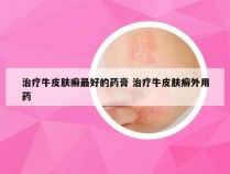 治疗牛皮肤癣最好的药膏 治疗牛皮肤癣外用药