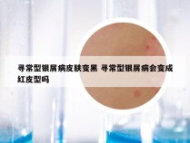 寻常型银屑病皮肤变黑 寻常型银屑病会变成红皮型吗