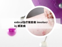 enbrel治疗银屑病 involucrin 银屑病