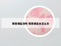 银屑病起泡吗 银屑病出水怎么办