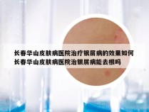 长春华山皮肤病医院治疗银屑病的效果如何 长春华山皮肤病医院治银屑病能去根吗
