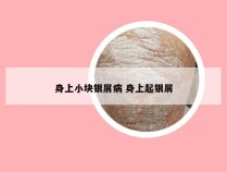 身上小块银屑病 身上起银屑