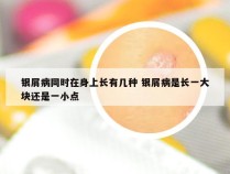 银屑病同时在身上长有几种 银屑病是长一大块还是一小点