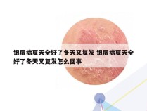 银屑病夏天全好了冬天又复发 银屑病夏天全好了冬天又复发怎么回事