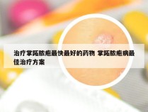 治疗掌跖脓疱最快最好的药物 掌跖脓疱病最佳治疗方案