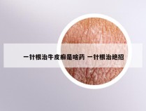 一针根治牛皮癣是啥药 一针根治绝招