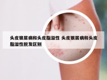 头皮银屑病和头皮脂溢性 头皮银屑病和头皮脂溢性脱发区别