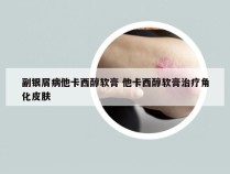 副银屑病他卡西醇软膏 他卡西醇软膏治疗角化皮肤