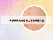 头部银屑病疙瘩 头上银屑病起的包