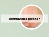 银屑病阴虚还是阳虚 银屑病表现为