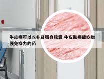 牛皮癣可以吃补肾强身胶囊 牛皮肤癣能吃增强免疫力的药