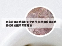 北京治银屑病最好的中医院 北京治疗银屑病最权威的医院专家是谁