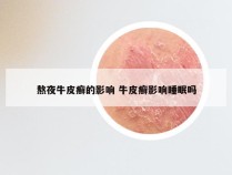熬夜牛皮癣的影响 牛皮癣影响睡眠吗