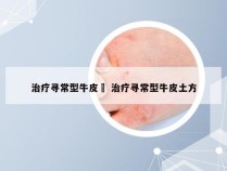 治疗寻常型牛皮廯 治疗寻常型牛皮土方