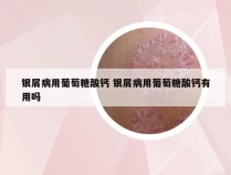 银屑病用葡萄糖酸钙 银屑病用葡萄糖酸钙有用吗