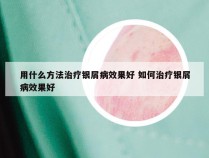 用什么方法治疗银屑病效果好 如何治疗银屑病效果好