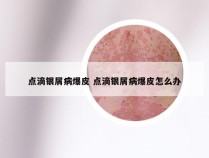 点滴银屑病爆皮 点滴银屑病爆皮怎么办