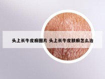 头上长牛皮癣图片 头上长牛皮肤癣怎么治