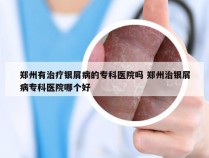 郑州有治疗银屑病的专科医院吗 郑州治银屑病专科医院哪个好