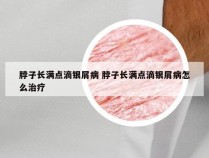 脖子长满点滴银屑病 脖子长满点滴银屑病怎么治疗