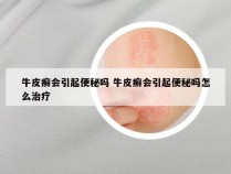 牛皮癣会引起便秘吗 牛皮癣会引起便秘吗怎么治疗