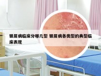 银屑病临床分哪几型 银屑病各类型的典型临床表现