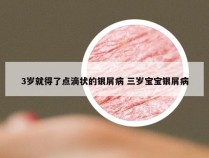 3岁就得了点滴状的银屑病 三岁宝宝银屑病