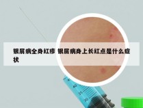 银屑病全身红疹 银屑病身上长红点是什么症状