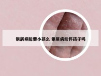 银屑病能要小孩么 银屑病能怀孩子吗