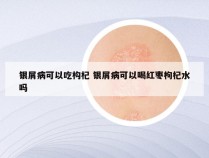 银屑病可以吃构杞 银屑病可以喝红枣枸杞水吗