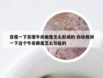 百度一下百度牛皮癣是怎么形成的 你给我讲一下这个牛皮癣是怎么引起的