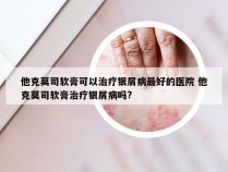 他克莫司软膏可以治疗银屑病最好的医院 他克莫司软膏治疗银屑病吗?