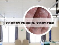 艾滋病会有牛皮癣的症状吗 艾滋病牛皮肤癣