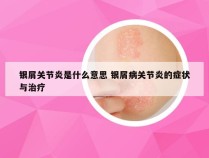 银屑关节炎是什么意思 银屑病关节炎的症状与治疗