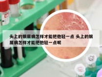 头上的银屑病怎样才能把他轻一点 头上的银屑病怎样才能把他轻一点呢