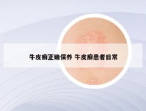 牛皮癣正确保养 牛皮癣患者日常