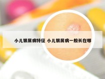 小儿银屑病特征 小儿银屑病一般长在哪