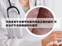 河南省有牛皮癣专科医院吗最正规的医院 河南治疗牛皮肤癣最好的医院
