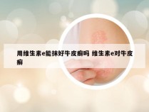 用维生素e能抹好牛皮癣吗 维生素e对牛皮癣