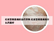 红皮型银屑病的治疗药物 红皮型银屑病用什么药最好
