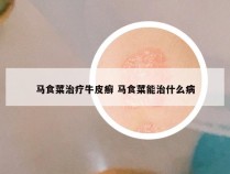 马食菜治疗牛皮癣 马食菜能治什么病