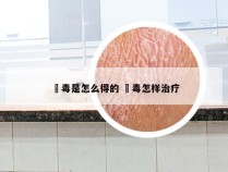 廯毒是怎么得的 栂毒怎样治疗