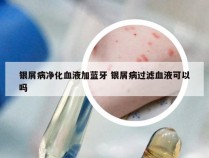 银屑病净化血液加蓝牙 银屑病过滤血液可以吗